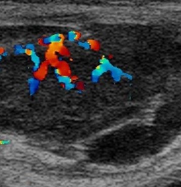echocardiogram VSD